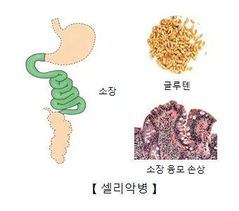 셀리악병