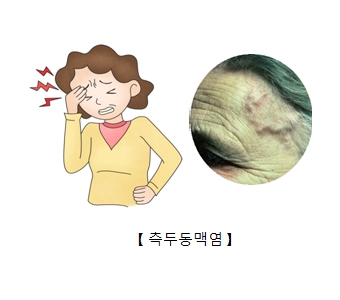 측두동맥염