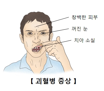 괴혈병