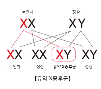 유약 X 증후군