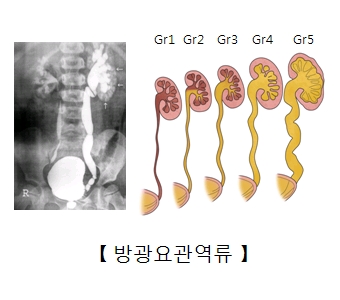 수신증