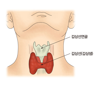 자가면역성 갑상선염