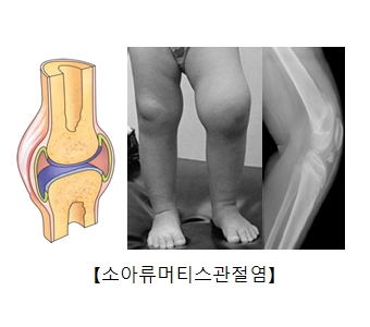 소아류머티스관절염