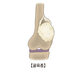 연부조직 육종