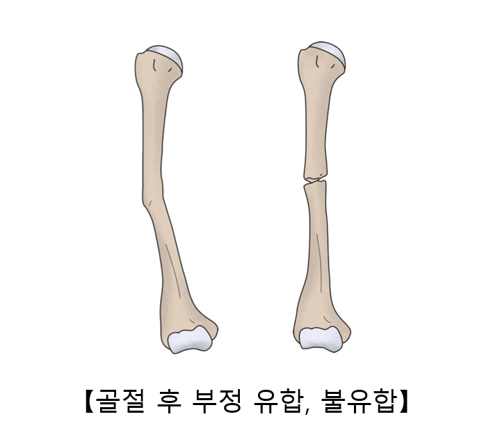 골절 후 부정 유합, 불유합