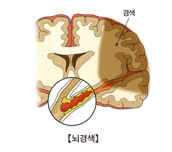 뇌경색