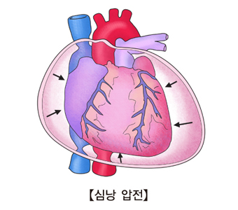 심낭 압전