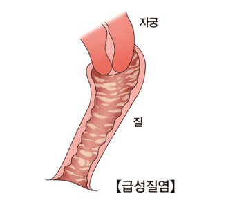 급성 질염