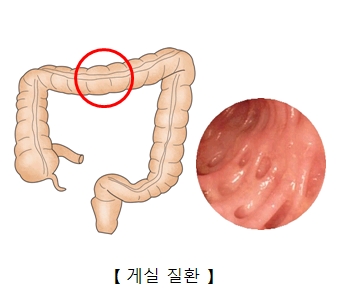 게실 질환