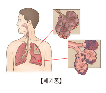 폐기종