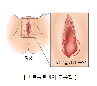 바르톨린샘의 고름집