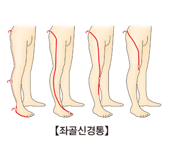 좌골신경통