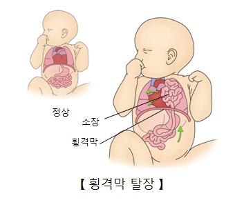 횡격막 탈장