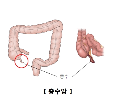 복막 가성점액종