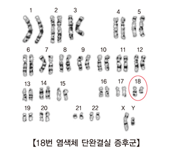 18번 염색체 단완결실 증후군