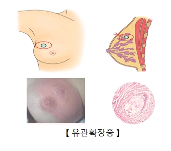 유관 확장증