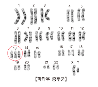 파타우 증후군