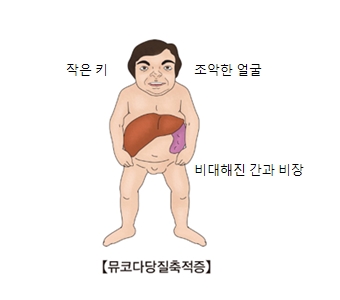 뮤코다당질축적증