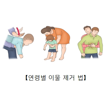 이물질에 의한 기도막힘