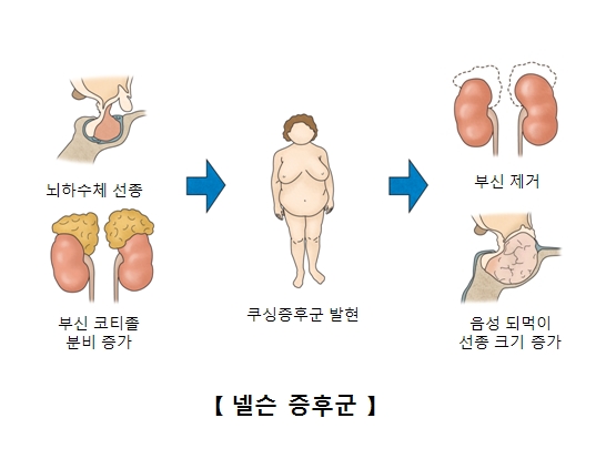 넬슨증후군