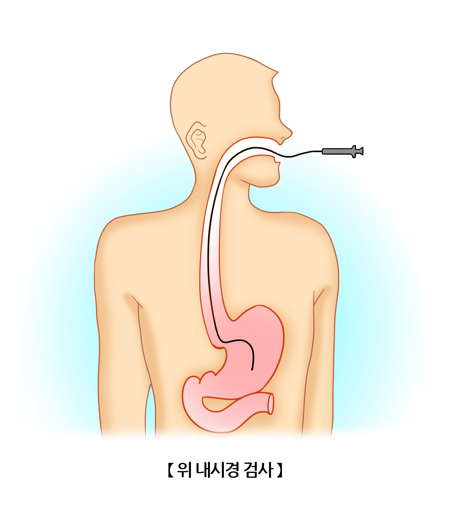 위내시경