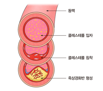 LDL-Cholesterol