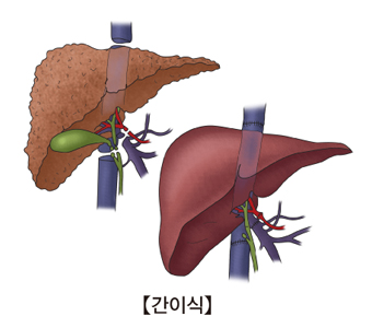 간이식