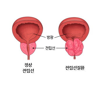 전립선