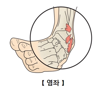 정보광장 > 자료실 > [의학] 염좌 (sprain)